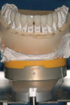 Frontal view of completed mandibular restorations.