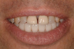 Frontal view of inserted mandibular restorations with untreated maxillary arch.