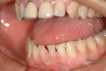 1.5-mm incisal reduction completed.
