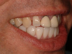 Lateral view of inserted mandibular restorations with untreated maxillary arch.