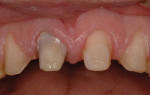 Renamel hybrid composite is utilized to block out the stain in tooth No. 8.
