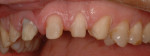 Renamel hybrid composite is utilized to block out the stain in tooth No. 8, lateral view.