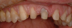 Renamel hybrid composite is utilized to block out the stain in tooth No. 8, lateral view.