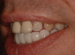 Lateral view of inserted mandibular restorations with untreated maxillary arch.