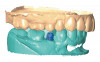Fig 1. Patient presents with existing smile challenges, restorations, and wear patterns.