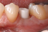 Fig 3. Preoperative restorative, including previously performed restorations.