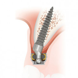 SATURNO™ Narrow Diameter Implant System by Zest Anchors, LLC