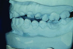 Fig 6 through Fig 8. This immediate digital denture process began with scanning the master casts.