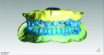 Fig 11 through Fig 13. The scans of dentate casts and duplicated trimmed casts were merged, and the overlay virtual design of an esthetic and functional occlusion digital denture was seen in different colors and transparencies.