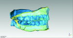 Fig 11 through Fig 13. The scans of dentate casts and duplicated trimmed casts were merged, and the overlay virtual design of an esthetic and functional occlusion digital denture was seen in different colors and transparencies.
