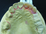 Fig 1 through Fig 4. The traditional immediate denture process requires technicians to conduct model surgery on mounted master casts. They then grind and set manufactured denture teeth one by one in their proper esthetic and functional positions.