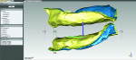 Fig 14. The digitized edentulous restorative space allowed a virtual analysis of inter-residual ridge space.