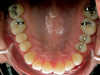 Fig 9. Direct composite was added intraorally to determine incisal edge position.