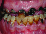 Fig 5. A patient presents with all 32 teeth needing to be extracted.