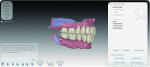 Fig 17 through Fig 19. A completed digital artificial tooth arrangement is seen, achieving an esthetic and functional occlusion.