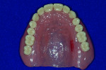 Fig 20 through Fig 22. The true test of a virtually designed esthetic and functional occlusion is how the digital dentures appear in the oral environment during speaking and smiling (clinical photos courtesy of Gary Laine, DDS, Palo Alto, California).
