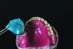 Fig 9. The palatal anatomy of the patient is transferred to the wax-up with the use of putty impression material.