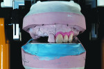 Fig 7. Left anterior teeth are set up and verified to the new plane of occlusion.