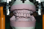 Fig 5. Model analysis is performed, and the borders of the tooth removal are marked.