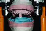Fig 6. The plane of occlusion is established by alignment of the anterior tooth and the three-quarter mark the retromolar pads.