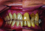Fig 14. A side-by-side comparison of the inserted denture and preoperative dentition.
