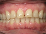 Figure 5  Frontal view after orthodontic treatment.