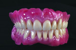 Fig 13. GC Gradia gum gingival facing with Optiglaze nano varnish on the completed case.