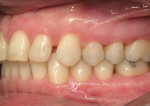 Figure 6  Left lateral view after orthodontic treatment.