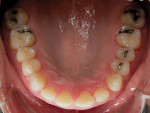 Figure 8  Occlusal view after orthodontic treatment.