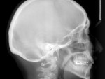 Figure 9  Lateral cephalogram after orthodontic treatment.