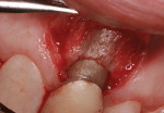 Surgical photo showing the paper-thin bone supporting the facial aspect of tooth No. 9.