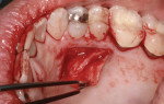 Surgical photo demonstrating the technique to harvest a subepithelial connective tissue graft from the left palate.