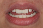 With the patient’s lips in repose, note the central incisors have a 6 mm display, while the cusp tips of the canines are at the level of the lips with almost no display