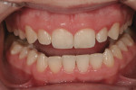 Close-up retracted view of the patient’s maxillary anterior teeth shows no incisal wear. Note the poor crown width-to-height ratio, especially in the central incisors, where they appear to exhibit a slightly wider mesial-distal dimension than the height.