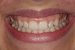 Close-up of the patient’s smile displaying excessive tissue and unesthetic crown width-to-height ratio.