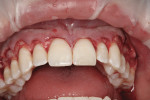 The inter-dental papillae are preserved by placing the incision facial to the tooth embrasures to facilitate the healing process and avoid “black triangles.”