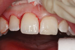 Gingivectomy from teeth Nos. 3 through 8 establishes the location of the future free gingival margins and demonstrates the amount of enamel exposed, allowing greater tooth display while diminishing tissue display.