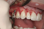 A coarse diamond football-shaped bur is used to smooth and feather edge the alveolus where the ostectomies were performed to enhance better tissue adaptation.