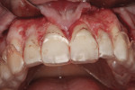 The surgical guide confirms the anticipated free gingival margin at the CEJs and its reference to the newly established osseous crest. The re-establishment of the dental-gingival complex during healing will fill in the space from the edges of the surgical guide to the newly created osseous crests.