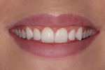 The patient at full smile at 3 months post surgery with a much more normal amount of tooth display.