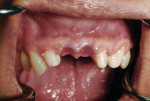 Buccal view of the anterior maxilla demonstrating preservation of the papilla due to the provisional bridge.