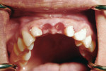 Occlusal view of the anterior maxilla demonstrating preservation of the papilla due to the provisional bridge.