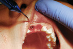 Picasso diode laser initiating uncovery of the healing screws in the implants at the central incisors.