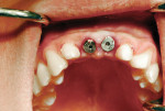 Healing abutments have been placed to allow tissue healing before impressions are taken.