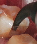The gingival portion of the proximal box can be seen early in the filling process because a clear matrix band is used. Note the perfect adaptation of the SonicFill composite material to this critical area of the cavity.