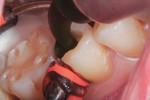 The SonicFill tip is delivered to within about 1 mm of the gingival wall of the proximal box. As the operator holds the tip in place, SonicFill material is expressed, flowing laterally toward the vertical walls. As the proximal box fills with material, the tip is slowly withdrawn. This technique will ensure precise filling of the cavity preparation without the need to “condense” the material with a hand instrument.