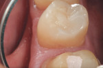 A proximal view of a completed disto-occlusal composite restoration on tooth No. 29. Note the restoration margins are virtually invisible and undetectable.