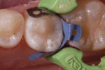 An occlusal view of a Class II disto-occlusal preparation after filling and sculpting with SonicFill 2. Isolation has been achieved using Isolite (Isolite Systems, www.isolitesystems.com).