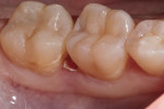An occluso-facial view of a recently placed disto-occlusal Sonicfill 2 restoration in tooth No. 30. Note the natural luster and blending of the restorative material with the surrounding tooth structure.