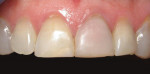 Discolored maxillary central incisor restored with resin composite veneer.